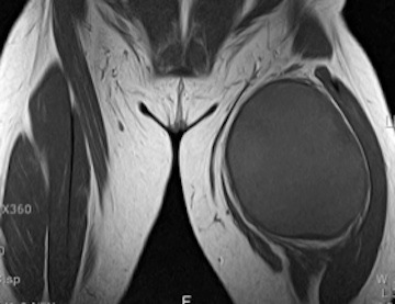 Figure 3 for case Benign Fibrous Histiocytoma